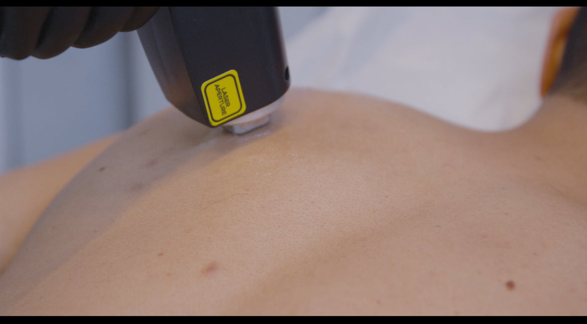 Chest Laser Hair Removal